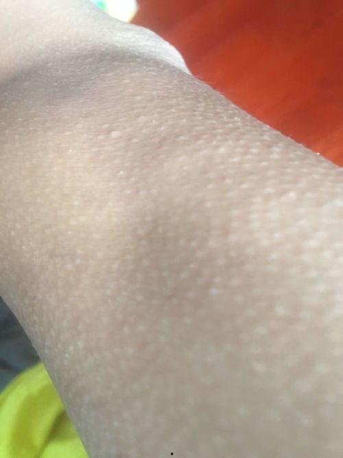 鸡皮疙瘩,探寻鸡皮疙瘩背后的神秘魅力